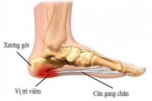 Bác sĩ cảnh báo đừng coi thường viêm cân gan bàn chân