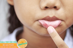 Nhiệt, viêm loét miệng ăn uống khó khăn nhớ áp dụng cách đơn giản này một lần đỡ hẳn
