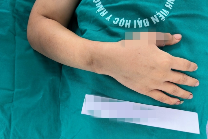 phẫu thuật nối chi
